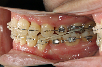 矯正装置の解説